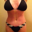 Five Weeks post op tummy tuck