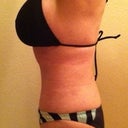 Five Weeks post op tummy tuck