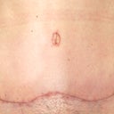 5 weeks TT scar