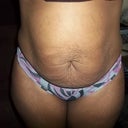 front veiw pre-op
