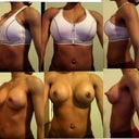 The zipper bra recommended to me by the nurse for more support while I continue to heal (Walmart). Just providing different angles. Haven't had a BM yet so a little bloated in the picts.