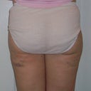 Just 36 hours post op! Minimal bruising and already I can see a big difference! Wow! I can't wait to see the results over the next couple of months!