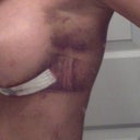 Yeah..there is the right side again! If it weren't for this, I could wear some cute clothes now!! You can see that the bruising is also the imprint of my sports bra!!