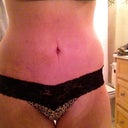 one week post-op!