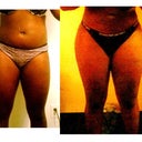 Before and after-5 weeks after surgery