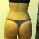 3 weeks post op