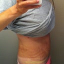 2 week PO Side