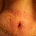 SWELL HELL! Stretch marks aka the ghost of the Pink Marshmallow! 13 days PO