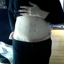 10 days post op. (navel is not off center - it's the angle I was standing)