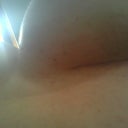Incision after 33 days! :)