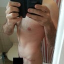 Post Op - 7 weeks - Including scar.