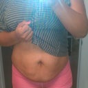 Before tt lipo back and flanks