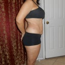 Side view three weeks after surgery