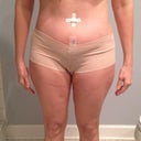 2 weeks post op - belly button plug - swelling or just not enough fat taken out?? legs look the same as i started