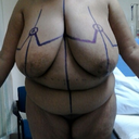 markings on the day of surgery. Dr said everything under the lines will be removed...lol