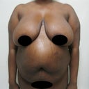 2 weeks before surgery
