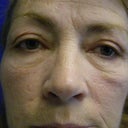 8 months after on my eyes