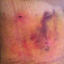 Post op 2 weeks - Bad Bruising!