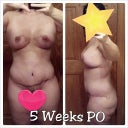 5 Week Post OP - see how swollen the tops of my hips are?  It goes up and down.  :/
