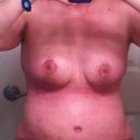 22 days post op - Front view, moderate evening swelling and lovely compression garment wavy lines