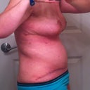 22 days post op - side view