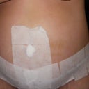 Day 4 post-op