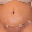 Day 7 post-op.  Glad to have the big tape off!  Brand new belly button.  I still have stretch marks but none are above my belly button now and they aren't as loose.