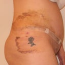 day 7 right side view.  bruising from the lipo.
