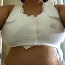 with post-surgical bra.  a bit of bleeding around nipple stopped.