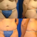 Before and 6 months post of my stomach