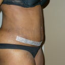 3WPO Close up of lower abs- sure hope this goes down