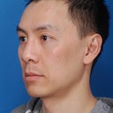 Asian Rhinoplasty