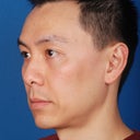 Asian Rhinoplasty