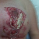 my wound was left to get like this