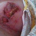 deteriorating wound