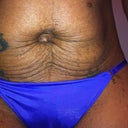 Stretch marks and loose skin when slightly bent over!