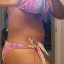 p.o day 10 side view.. still a lil bruised from the lipo but looks better day by day..,.