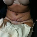 24 hours post op