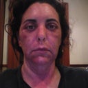 12 Hours after treatment