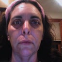 Before Treatment