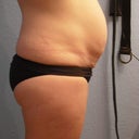 night before tummy tuck
