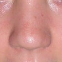 after - I feel like my nose actually looks BIGGER now from the front :/