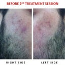 BEFORE SECOND TREATMENT SESSION