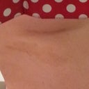 Breast scar, barely visable