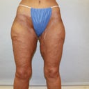47 Y.o With Body Lift