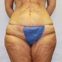 47 Y.o With Body Lift