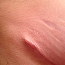 My scar dog eared as it healed. This wil be fixed early May.