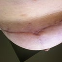 12 Weeks PO - Left breast scar