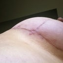 12 Weeks PO - Right breast scar