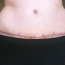 12 Weeks PO - TT scar